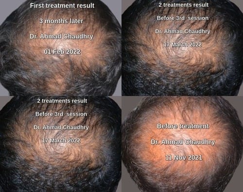 Platelet rich plasma and hair regrowth treatment clinic Lahore Pakistan