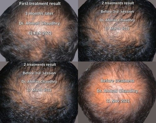 Platelet rich plasma and hair regrowth treatment clinic Lahore Pakistan Platelet rich plasma and hair regrowth treatment clinic Lahore Pakistan