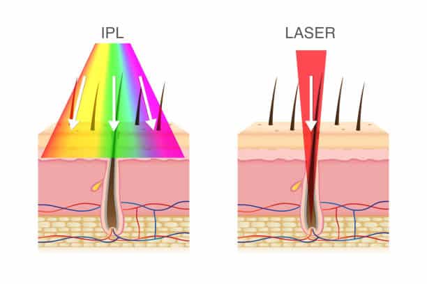 IPL Vs Laser