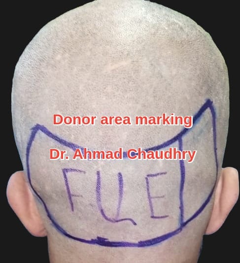 Donor area marking -shave