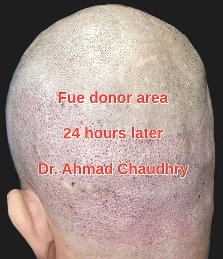Fue donor area 2443 grafts extraction