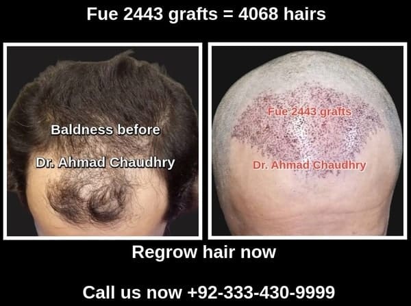 Fue hair restoration Gujranwala patient