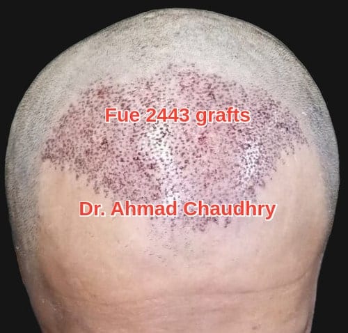 Hair surgery Pakistan