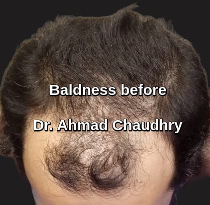 Hair transplant Gujranwala