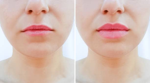 lip enhancement Lahore