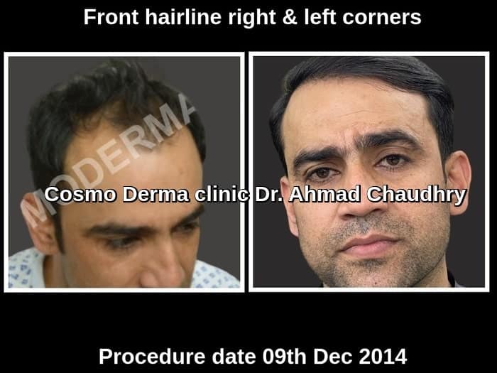 Fue hair transplant expectation after one year