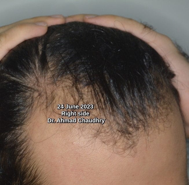 After receding hairline treatment Lahore Pakistan