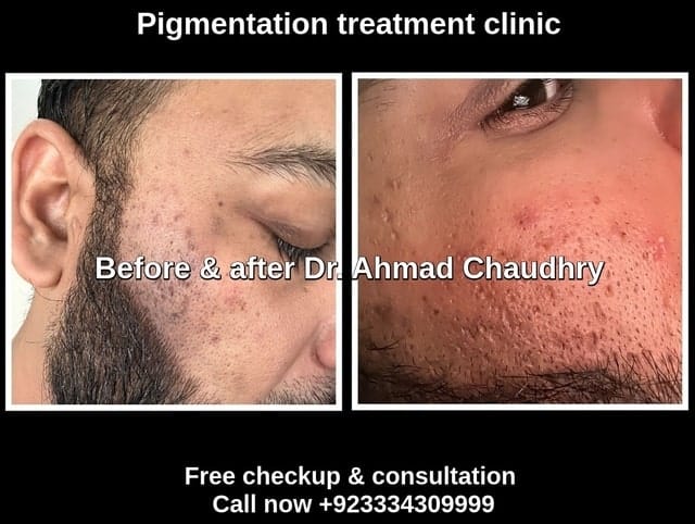 Best melasma treatment Lahore