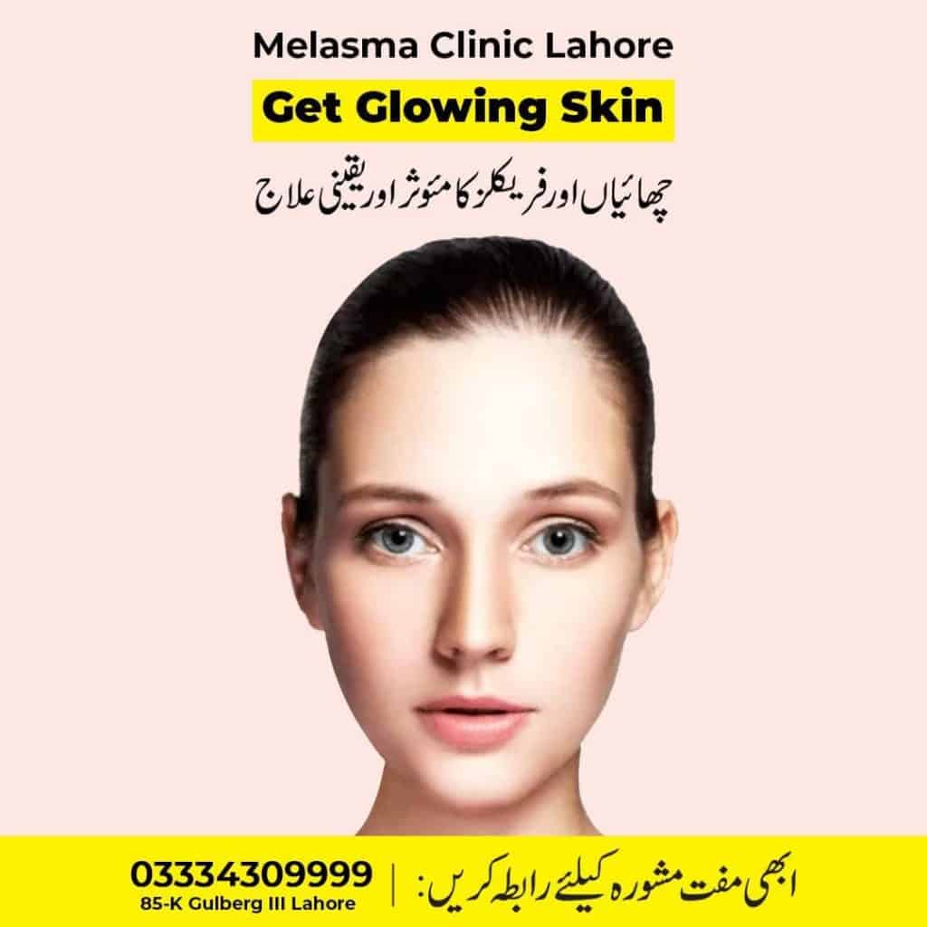 Freckles treatment clinic Lahore