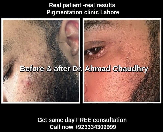 Pigmentation treatment results Lahore