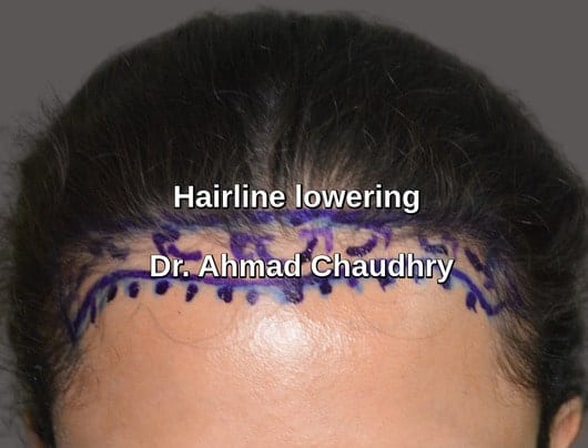 Hairline lowering surgery clinic