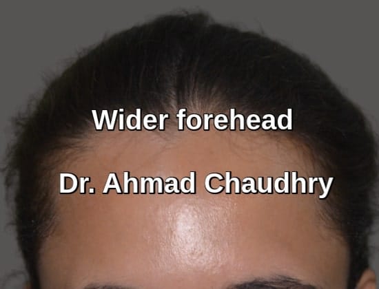 Wider forehead surgery