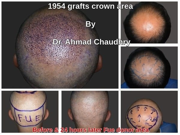 Androgenetic alopecia treatment Lahore