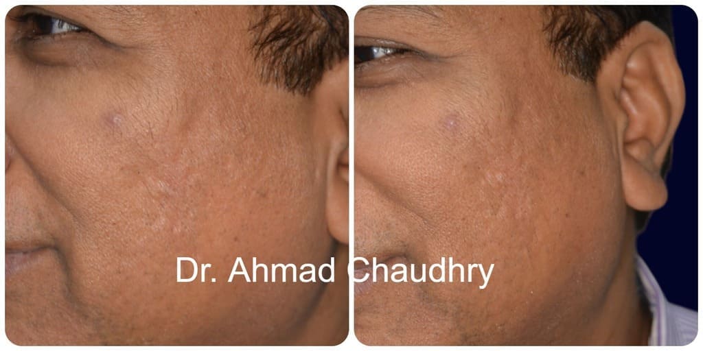 Acne pores result Lahore