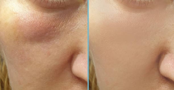 Cheeks dilated pores solution