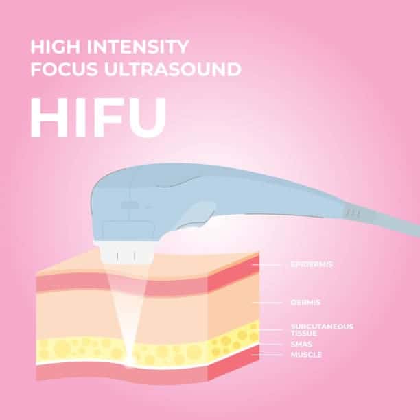 HIFU High intensity focused ultrasound