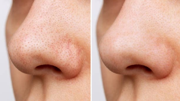 Nose fractional laser treatment clinic Lahore