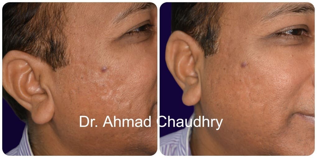 Pimple scar result Lahore
