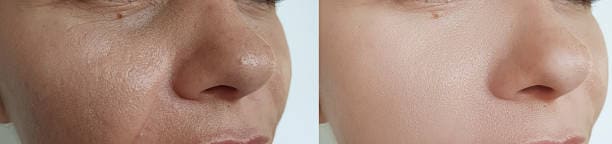 open pores treatment Lahore